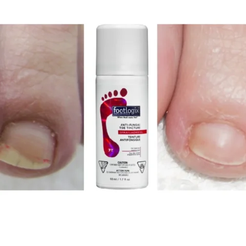 Footlogix Toe Nail Tincture Spray - Image 3